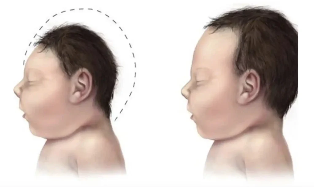 Phenylketon niệu (PKU) ở Trẻ Sơ Sinh tại Quy Nhơn: Nguyên Nhân, Triệu Chứng và Sàng Lọc Sơ Sinh