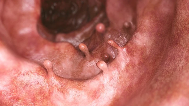 Nội soi cắt polyp đại tràng tại Phòng khám Đa khoa Hòa Đức, Quy Nhơn – Quy trình thực hiện và có đau không?