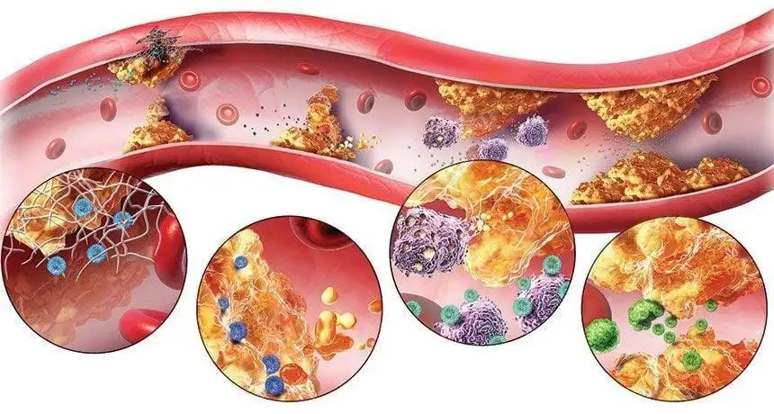 Rối Loạn Mỡ Máu: Nguyên Nhân, Triệu Chứng và Cách Kiểm Soát Hiệu Quả Qua Xét Nghiệm và Điều Trị tại Quy Nhơn