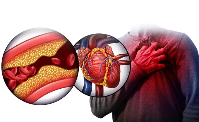 Rối Loạn Mỡ Máu: Nguyên Nhân, Triệu Chứng và Cách Kiểm Soát Hiệu Quả Qua Xét Nghiệm và Điều Trị tại Quy Nhơn