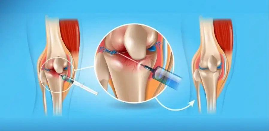 Tiêm khớp gối tại Quy Nhơn – Giải pháp giảm đau, phục hồi vận động