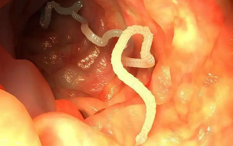 Giun sán nguyên nhân nhiều ca nhiễm ký sinh trùng ở Quy Nhơn Bình Định