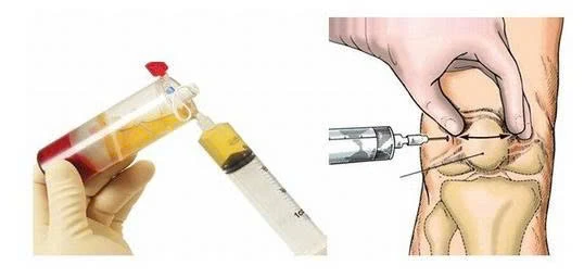 Tiêm khớp gối tại Quy Nhơn – Giải pháp giảm đau, phục hồi vận động