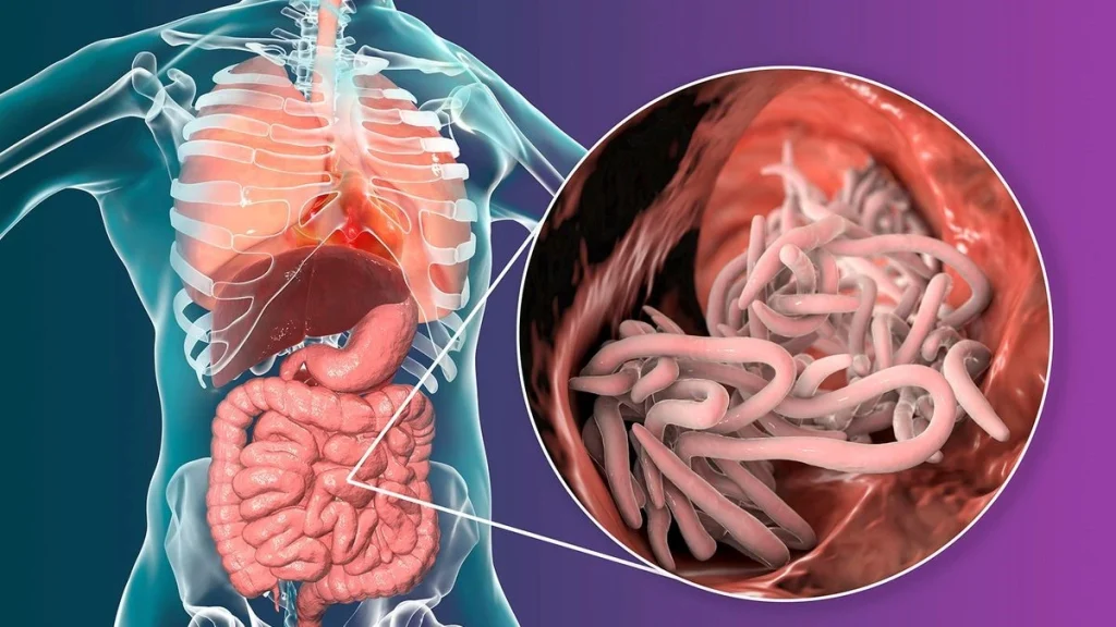 Bệnh Giun đũa – Xét nghiệm, chẩn đoán và điều trị dứt điểm