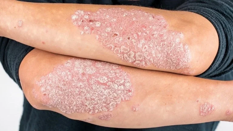 Bệnh vảy nến: Nhận biết – Chẩn đoán – Điều trị hiệu quả tại Quy Nhơn