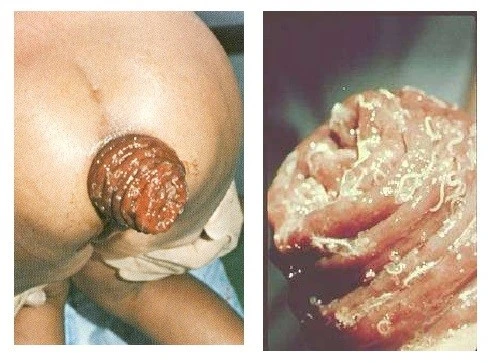 Xét nghiệm và điều trị bệnh giun tóc tại Quy Nhơn – Phòng khám Đa khoa Hòa Đức