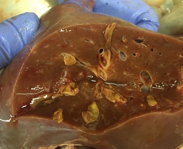 Bệnh sán lá gan – Nguyên nhân, triệu chứng, chẩn đoán và điều trị hiệu quả tại Quy Nhơn