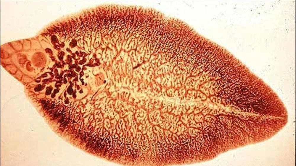 Bệnh sán lá gan – Nguyên nhân, triệu chứng, chẩn đoán và điều trị hiệu quả tại Quy Nhơn