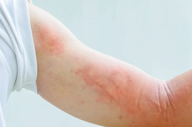 Dị ứng nổi mề đay: Nguyên nhân, triệu chứng và hướng điều trị hiệu quả tại Quy Nhơn