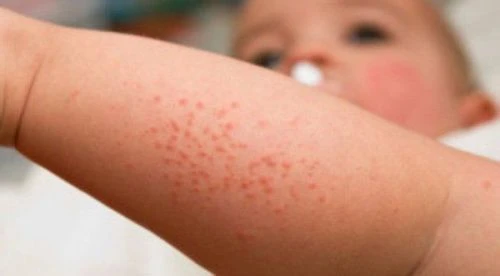 Bệnh chàm (Eczema) là gì? Nguyên nhân, triệu chứng và cách điều trị hiệu quả