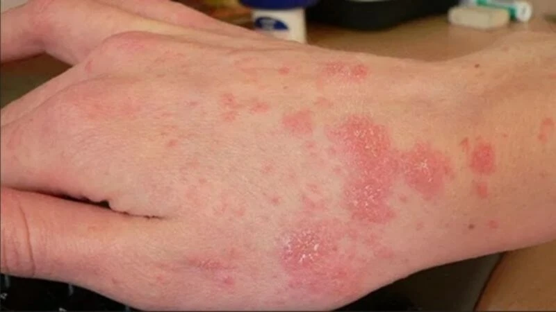 Bệnh chàm (Eczema) là gì? Nguyên nhân, triệu chứng và cách điều trị hiệu quả
