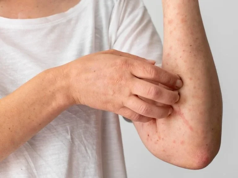 Viêm Da Tiếp Xúc – Triệu chứng, chẩn đoán và cách điều trị