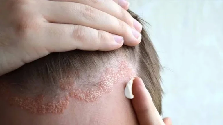 Viêm Da Tiết Bã: Nguyên Nhân, Triệu Chứng, Cách Điều Trị Và Chăm Sóc Hiệu Quả