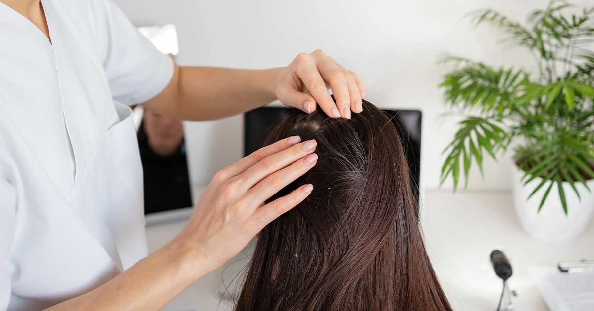 Nấm da đầu là bệnh gì? Triệu chứng & cách điều trị hiệu quả tại Quy Nhơn