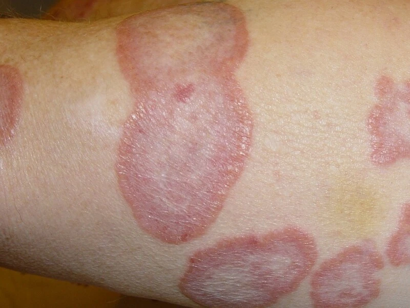 Hắc lào là bệnh gì? Dấu hiệu và cách điều trị hiệu quả tại Quy Nhơn