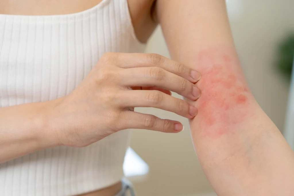 Tropical Skin Infection Treatment in Vietnam: A Quick Guide