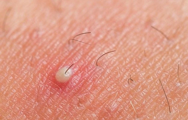 Tropical Skin Infection Treatment in Vietnam: A Quick Guide