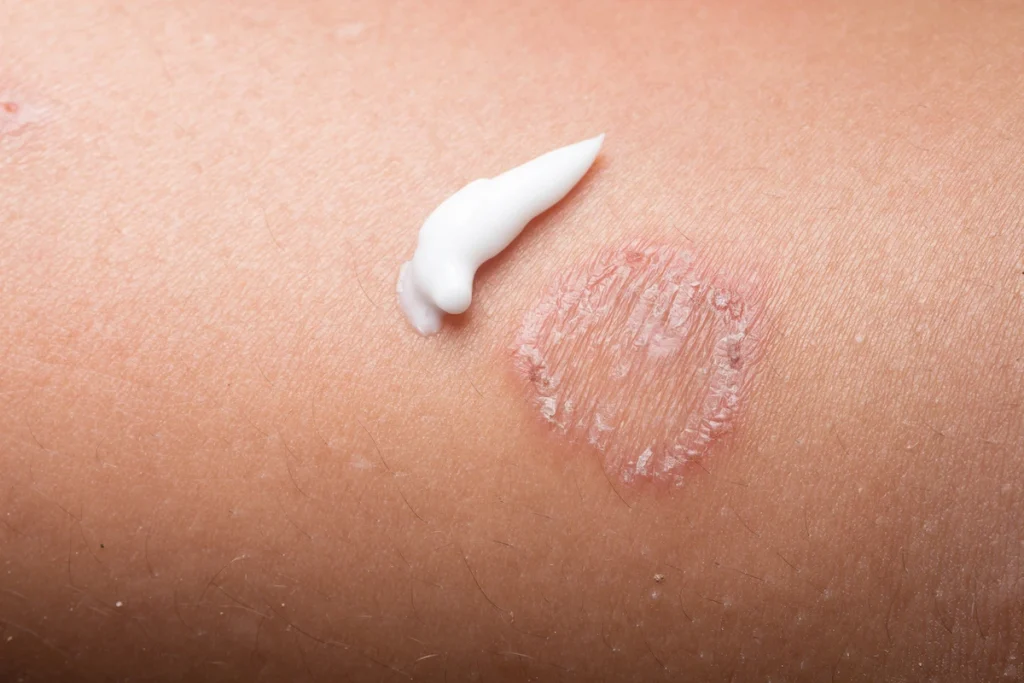 Fungal Skin Infection Treatment