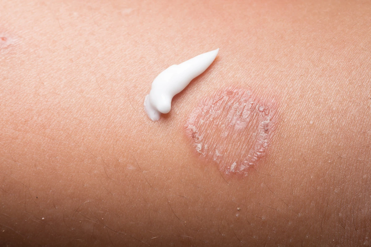Fungal Skin Infection Treatment
