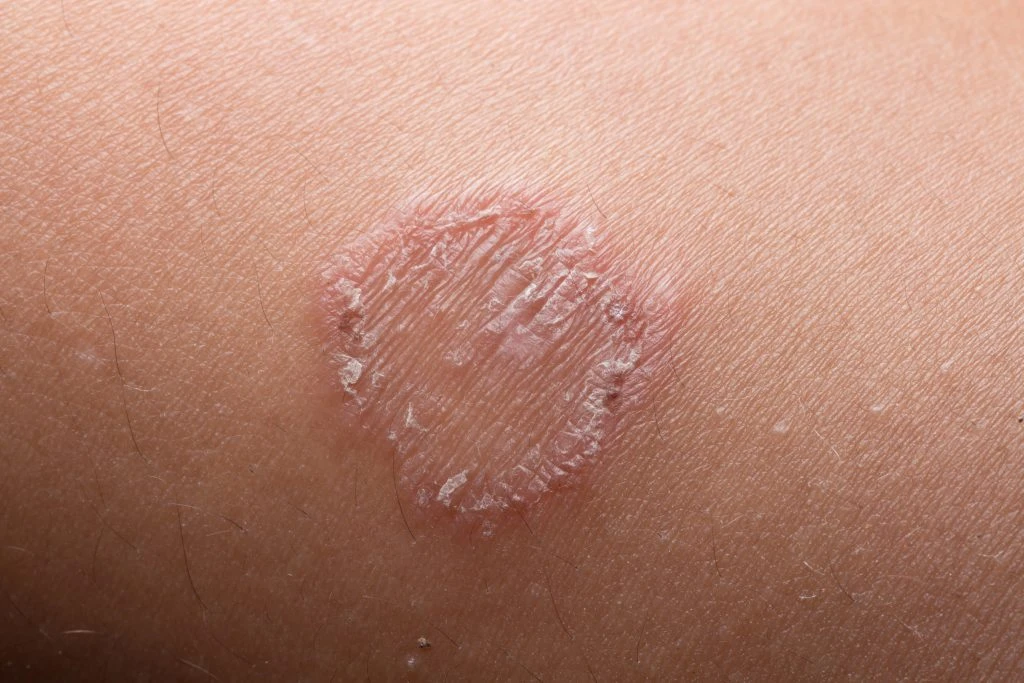 Tropical Skin Infection Treatment in Vietnam: A Quick Guide