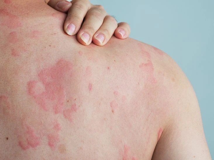 Skin Rash & Allergy Treatment in Quy Nhon : A Quick Guide