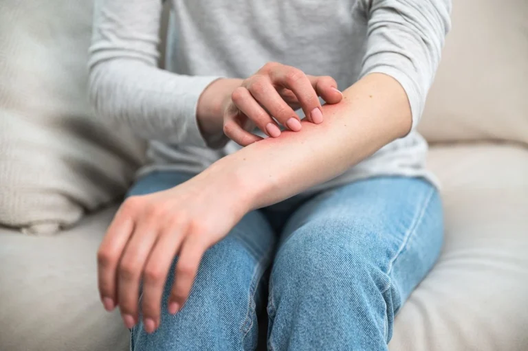 Skin Rash & Allergy Treatment in Quy Nhon : A Quick Guide