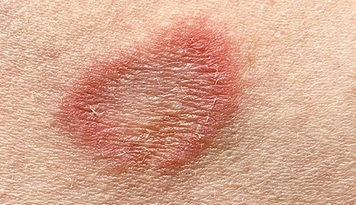 Fungal Skin Infection Treatment in Vietnam: A Quick Guide