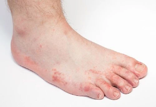 Fungal Skin Infection Treatment in Vietnam: A Quick Guide