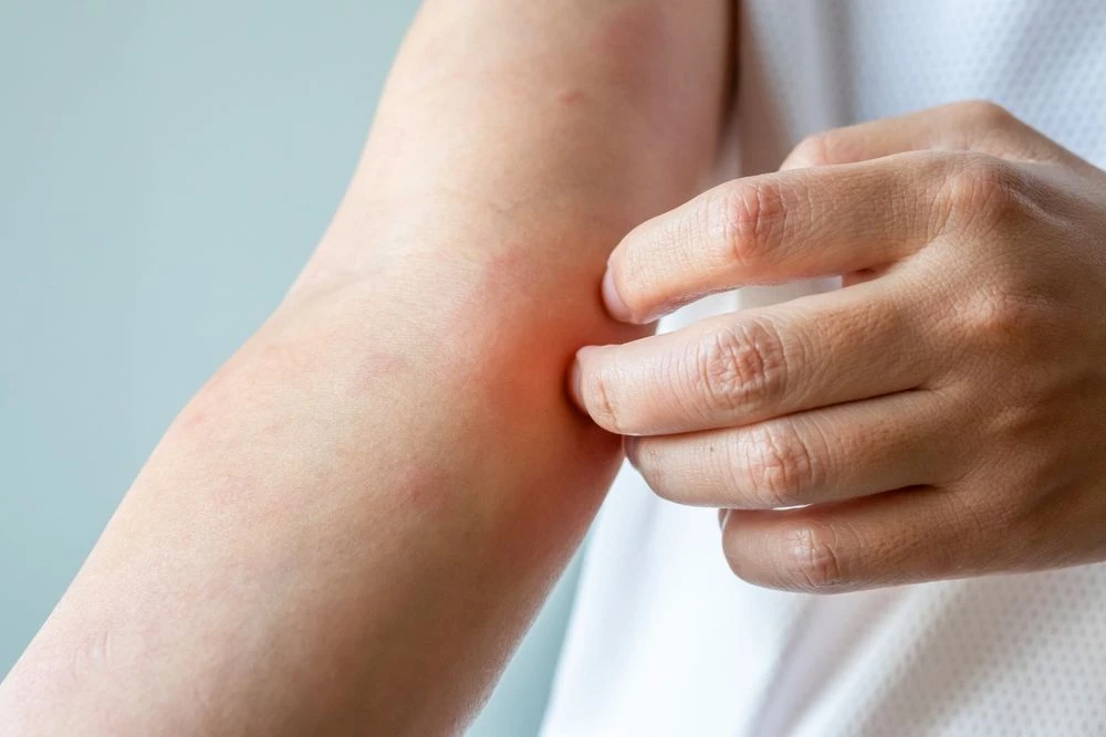 Tropical Skin Infections
