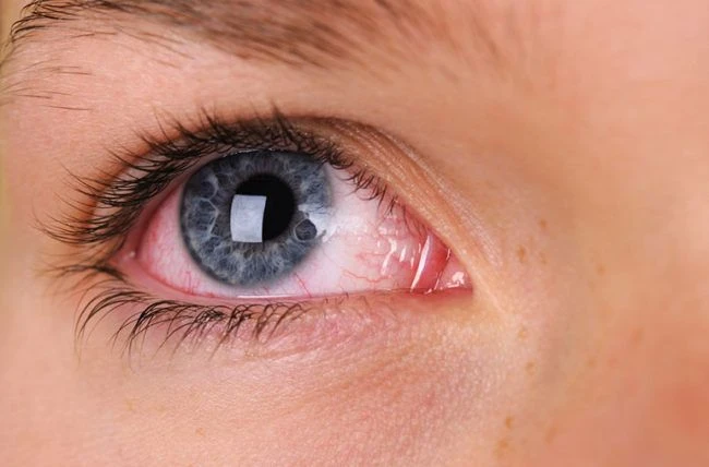 Eye Infection & Conjunctivitis Treatment: A Quick Guide