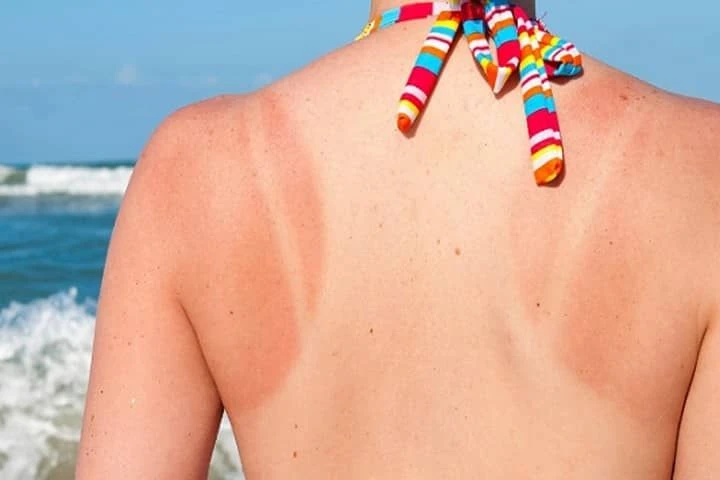 Sunburn Treatment in Quy Nhon : A Quick Guide