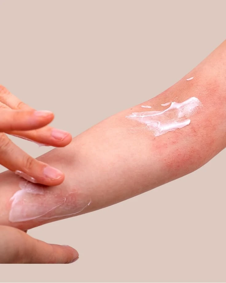 Heat Rash & Prickly Heat Treatment in Quy Nhon: A Quick Guide