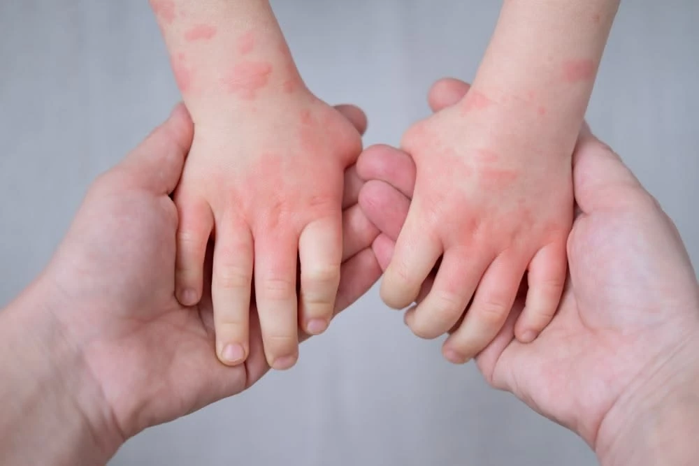 Eczema & Dermatitis Flare
