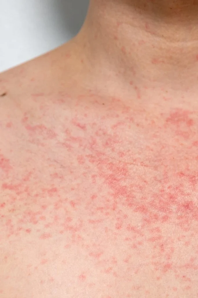 Heat Rash & Prickly Heat