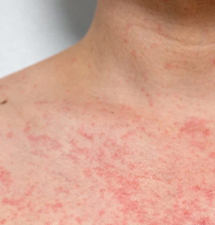 Heat Rash & Prickly Heat