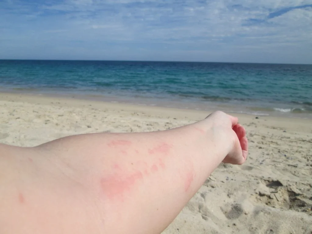 Jellyfish Sting Treatment