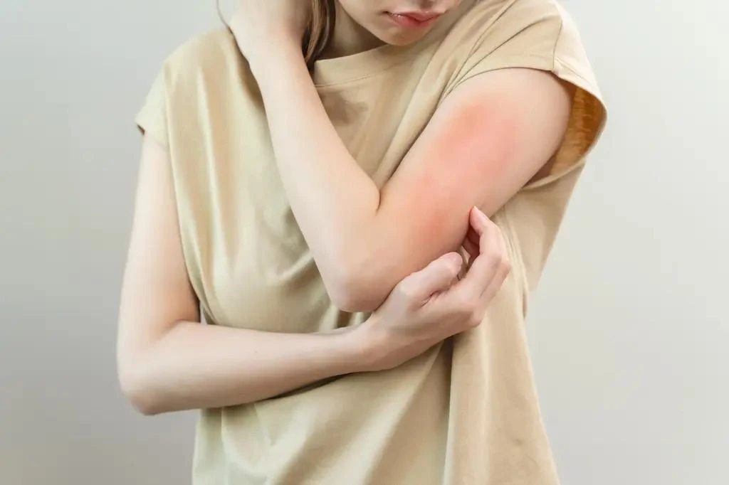 Heat Rash & Prickly Heat Treatment in Quy Nhon: A Quick Guide