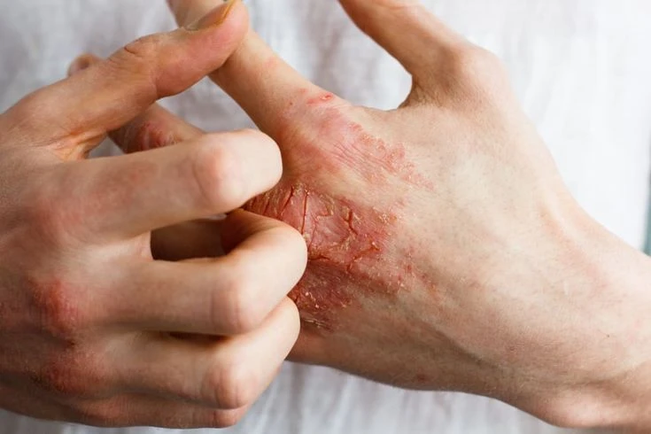 Eczema & Dermatitis Flare Treatment in Vietnam: A Quick Guide