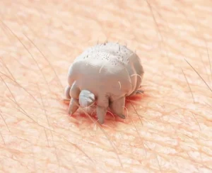 Scabies Treatment in Vietnam: A Quick Guide